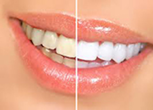 Vital and Non-Vital Professional Teeth Whitening in Pensacola, FL